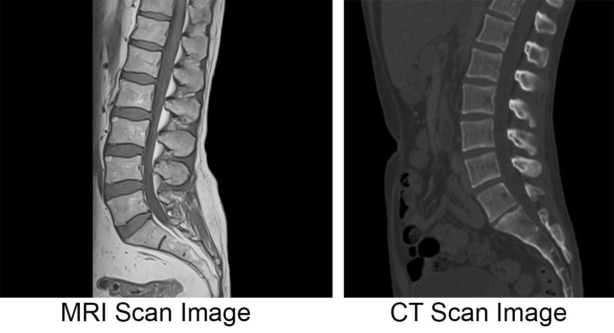 MRI vs CT Scan