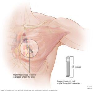 Cardiac Loop 